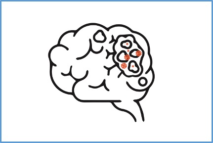 Homo sapiens / Non-Glioma Brain Cancer